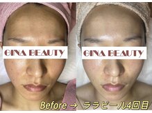 ジナ ビューティ(GINA BEAUTY)/ララピール４回目の効果