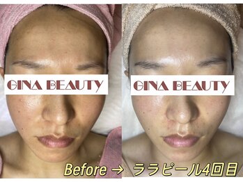 ジナ ビューティ(GINA BEAUTY)/ララピール４回目の効果