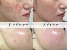 リララ(lelala)/ハーブピーリング