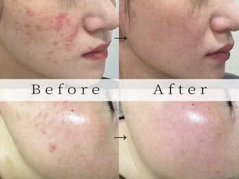 リララ(lelala)/ハーブピーリング