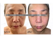 ツヤハダコガオ 千葉店/before⇒after【サーマリフト】