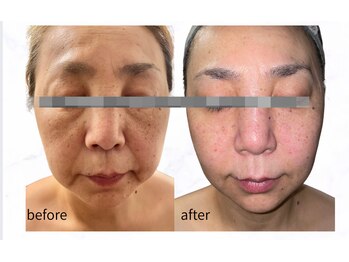 ツヤハダコガオ 千葉店/before⇒after【サーマリフト】