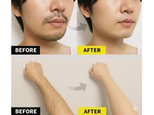 アンダ 前橋総社店(Anda)の雰囲気（最高出力３０００Wでメンズの太い体毛もしっかり効果実証済み！）