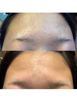 ブランシェ 富山店 × 椿/リージュセラム使用前後