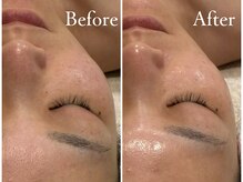 ラシック(La chic)/毛穴洗浄/ララピール大阪心斎橋