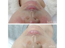 メルシア(merucia)の雰囲気（　【肌育ララピール】バリア機能を鍛えて強い肌を育てる）