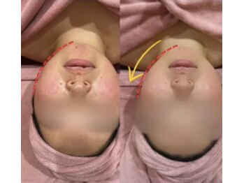 ラフィール/ブライダルエステ：小顔