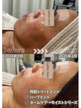 サロンノワ(salon noix)/《くすみ・シミケアに》