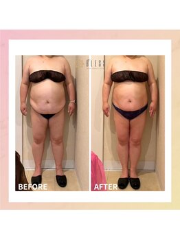 エステサロン ブレス 長町南店(BLESS)/痩身結果