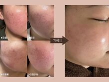 ダブリュービー(WB)/ハードハーブピーリング7回目