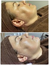 エーエフビューティーエステ(AF Beauty Esthetic)/50代肌質改善フェイシャル