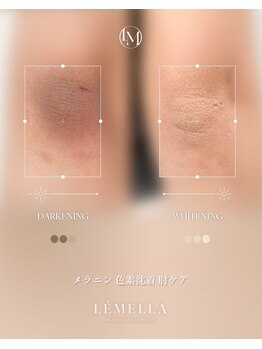 フリュール(FLEUR)/膝の黒ずみに♪メラニンケア
