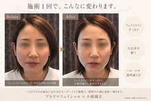 ビプレ(BIPURE)