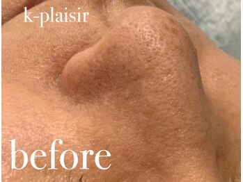 ケイ プレジール/ハイドラフェイシャル before