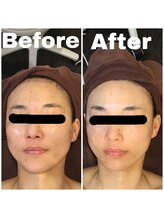 トータルビューティサロン エクスト(EXT)/GF導入80分＋ラフォスF☆半年後