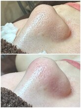 エクラ バイ シャンリィ(eclat by shanLy)/角栓詰まりの方必須！