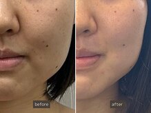 SEC(Shizuoka esthetic company)/【小顔×肌質改善】中顔面短縮