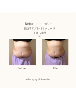 スリム(SLIM by lily of the valley)/お腹と脇腹脂肪冷却1回EMS1回