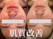 ルアナアイナ(Luana Aina)の雰囲気（ハーブピーリングで毛穴・ニキビケア　剥離なしハーブピーリング）