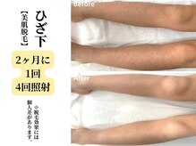 ベルホワイト(Belle White)/【美肌脱毛/ひざ下】