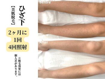 ベルホワイト(Belle White)/【美肌脱毛/ひざ下】