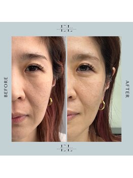 ホワイトラボ 姫路(White labo)/【施術例】エクソリフト/ExoLift