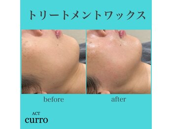 アクト クロ(ACT curro)/【フェイシャルエステ】施術例