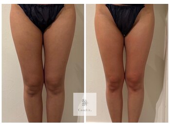 マシェリ 吉祥寺(Macherie)/太もも　内張りor外張りor前張り