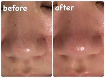 サロン マレ(salon mare)/毛穴洗浄コース