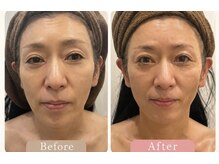 アランチャンティック(AlamCantik)の雰囲気（「テラボーラー×小顔美骨整顔」4回の効果♪東洋医学小顔美骨）