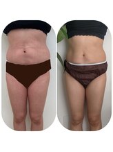 エクシア(EXCIA)/Before&After 4