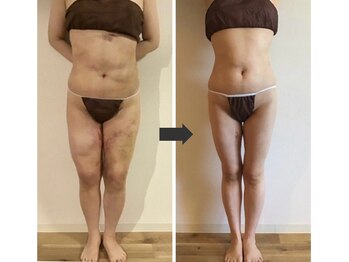 スリーピングビューティー(Sleeping Beauty)/インディバ　術後ケア