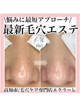 エクラーレ(Eclale)/【毛穴ケア】症例