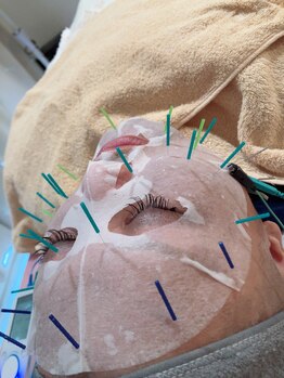 瑞 鍼灸院/幹細胞美容鍼