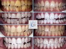 ラフ(LAUGH)/【審・美・白】 ホワイトニング