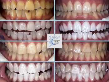 ラフ(LAUGH)/【審・美・白】 ホワイトニング