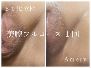 アメリー(Amery)/Before After