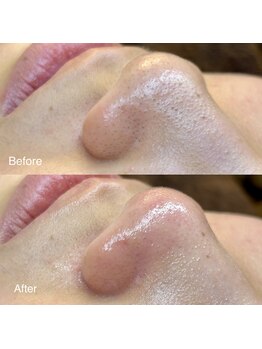 ピエル 柏店(PIEL)/毛穴エクストラクション