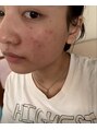 ピエル 北千住店(PIEL) 繰り返す肌荒れに悩んでいた時期。PIELの客として通っていました