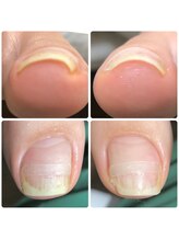 ネイル ウォッカ(NAiL VODKa)/【巻き爪ケア(B/S)】