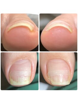 ネイル ウォッカ(NAiL VODKa)/【巻き爪ケア(B/S)】