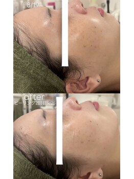 ビューティービューティー(beauty×beauty)/ハーブピーリングお客様結果
