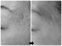 エフェクト 塚口店(effect)/Before After &nbsp;&nbsp;40代/2回目