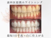 アトリエ 横浜店/最短ホワイトニングで圧倒的効果