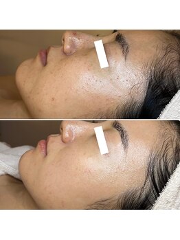 エクラムサロン 代官山(eclam salon)/施術BEFORE／AFTER