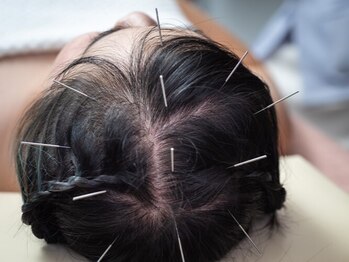 なかむら鍼灸院の写真/分け目や生え際が気になる方へ。育毛促進鍼で頭皮のお悩みを改善◎＜【1名様限定】育毛促進鍼新規￥2,980＞