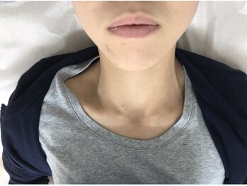 ピリナ(Plina)/光フェイシャル