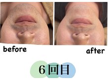 そらまめ/髭脱毛６回目です