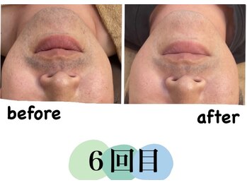 そらまめ/髭脱毛６回目です