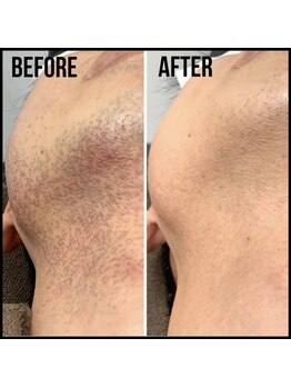 キビック(KIBIK)/【ヒゲ脱毛(フェイスライン)】